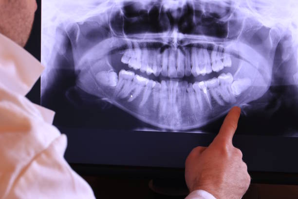 Best Dentist for Tooth Abscess  in Ishpeng, MI