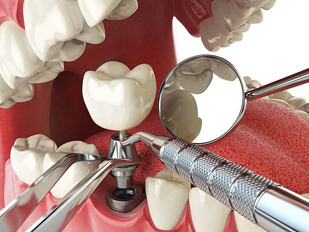 Best Cracked Tooth Emergency Dentist  in Ishpeng, MI